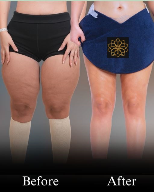 plastic surgery before after