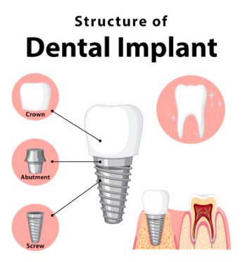 Dental Implants 3