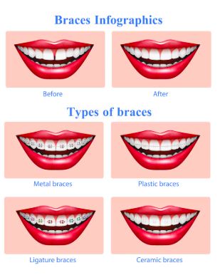 Orthodontic Treatment before-after 3