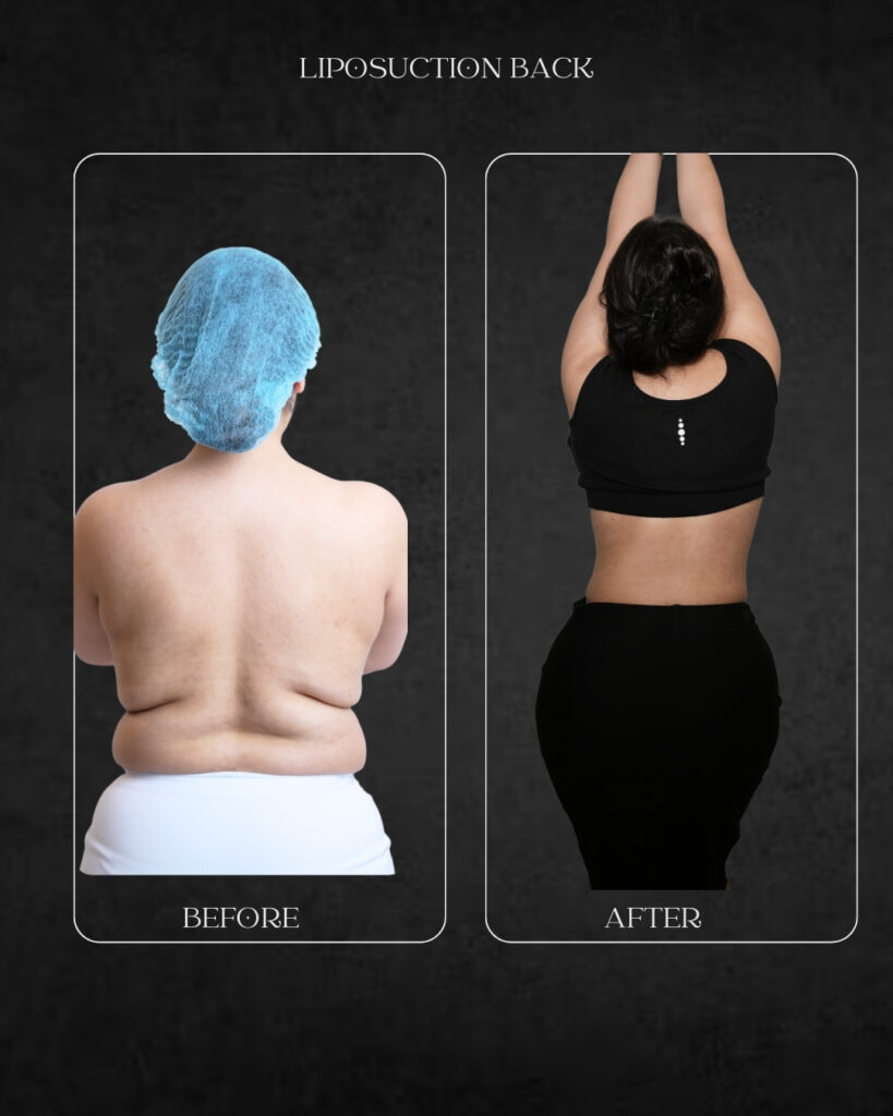 Liposuction Back