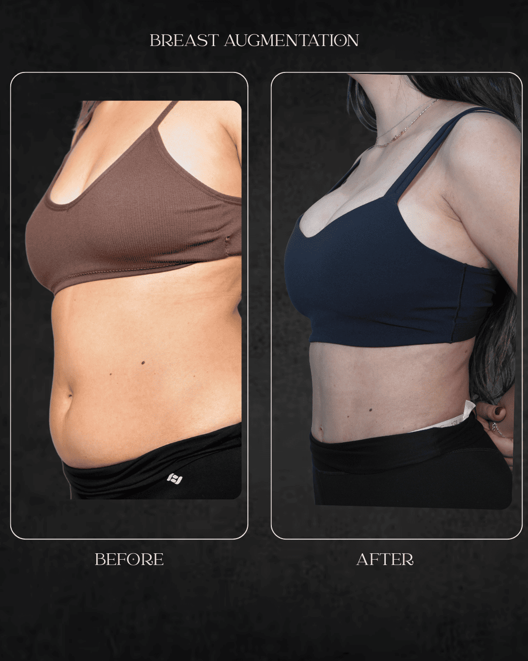 breast augmentation Beverly Hills specialist Hospital Abu Dhabi