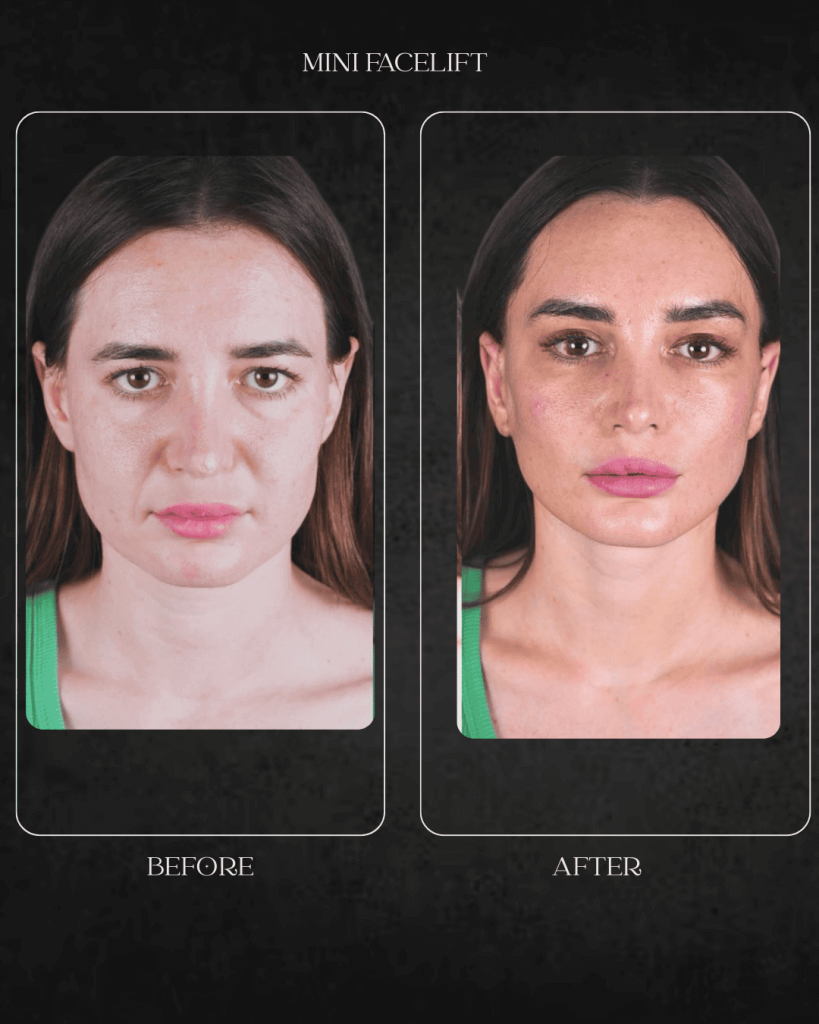 mini facelift Beverly Hills specialist Hospital Abu Dhabi
