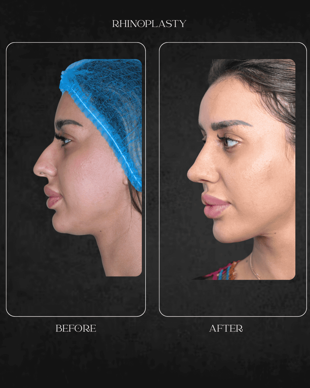 rhinoplasty Beverly Hills specialist Hospital Abu Dhabi