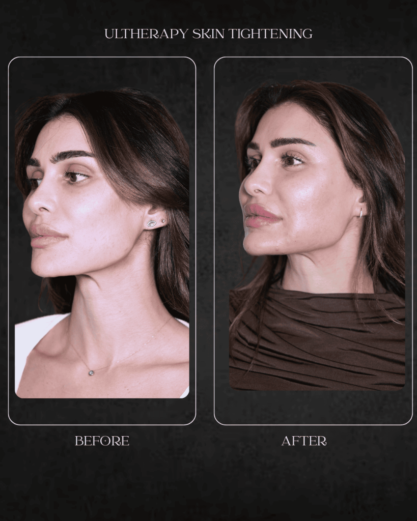 ultherapy skin tightening Beverly Hills specialist Hospital Abu Dhabi
