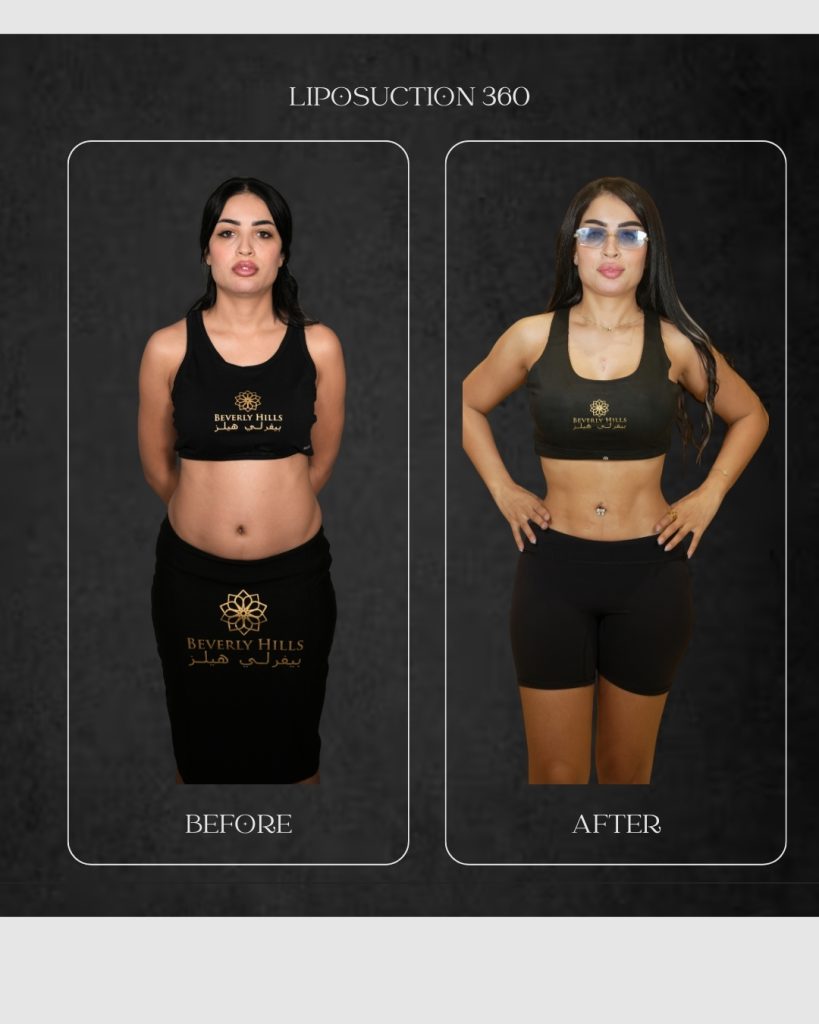 Dr Hamad Before After Results Liposuction