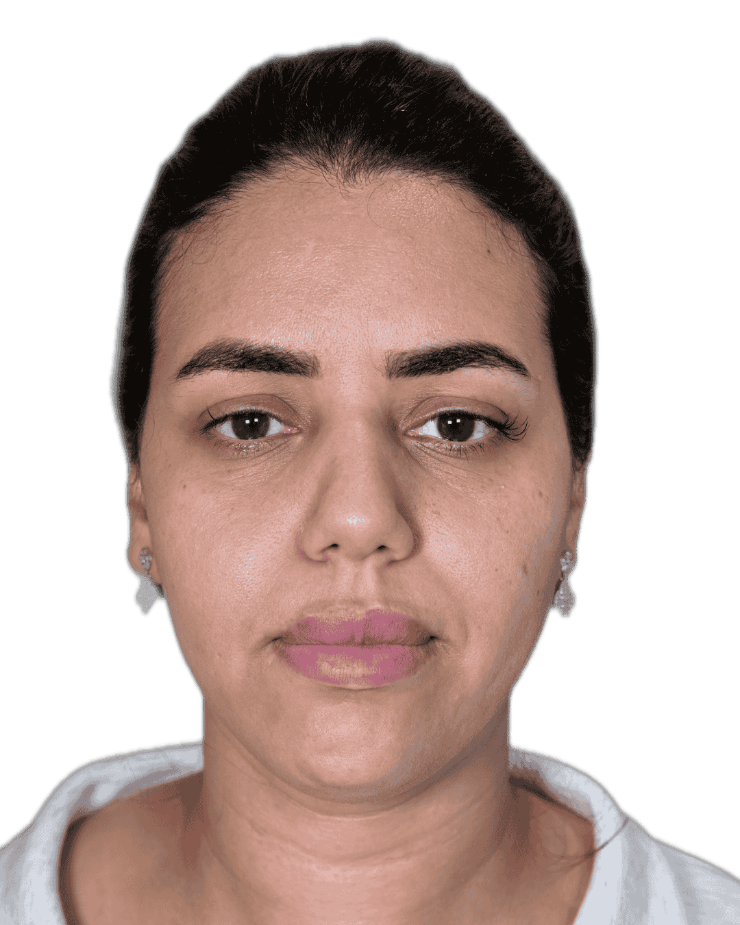 BEFORE PNG DERMA (1)