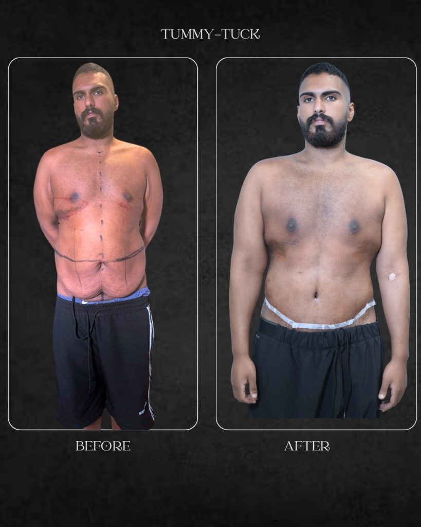 Tummy Tuck Before After BHSH